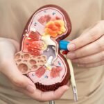 Kasus Batu Ginjal di Usia Produktif Meningkat, Herbal Jadi Terapi Pendamping