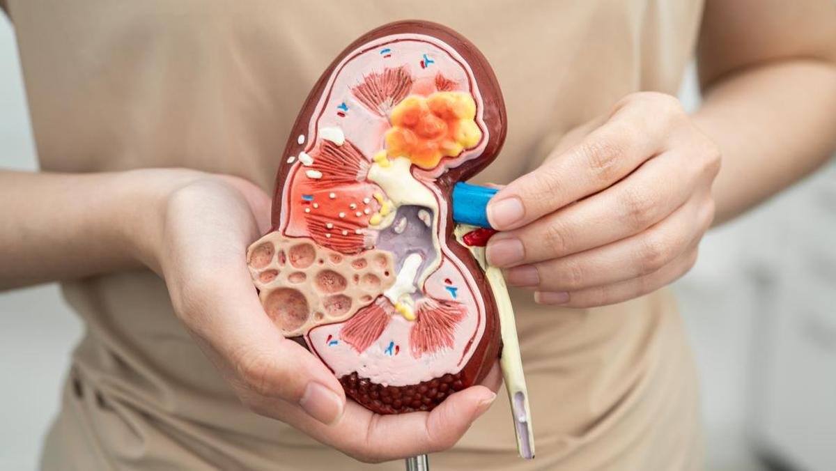 Kasus Batu Ginjal di Usia Produktif Meningkat, Herbal Jadi Terapi Pendamping